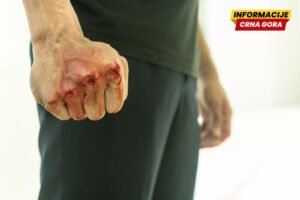 Podgorica: Dvojica maloljetnika povrijeđena, udarali ih telskopskim palicama i pesnicama?