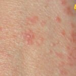 Kako počinje šuga?