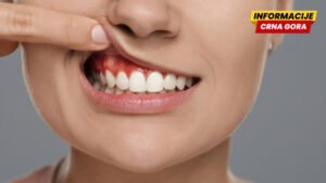 Desni vam često krvare - Nedostatak ovog vitamina može biti uzrok